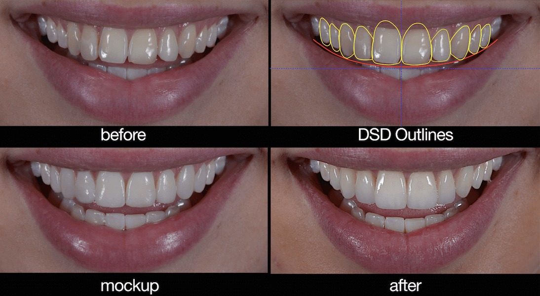 Morgan Street Dental Centre Smile Design Wagga- Smile Design Before and After Mock Illustration on Computer