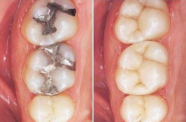 Morgan Street Dental Centre Tooth Coloured Fillings - Tooth Coloured Services Comparison with Silver Coloring