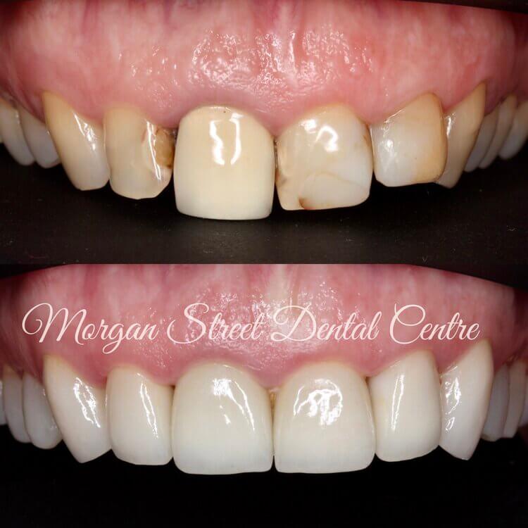 Cosmetic Dentistry Wagga Wagga at Morgan Street Dental Centre - Before and After Cosmetic Dentistry Comparison