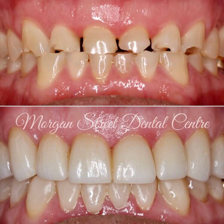 Cosmetic Dentistry Wagga Wagga at Morgan Street Dental Centre - Before and After Cosmetic Dentistry Comparison