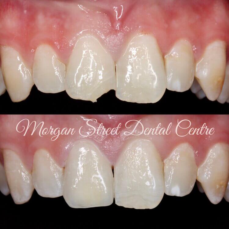 Cosmetic Dentistry Wagga Wagga at Morgan Street Dental Centre - Before and After Cosmetic Dentistry Comparison