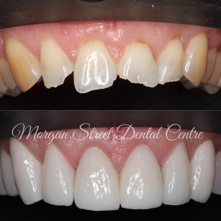 Cosmetic Dentistry Wagga Wagga at Morgan Street Dental Centre - Before and After Cosmetic Dentistry Comparison