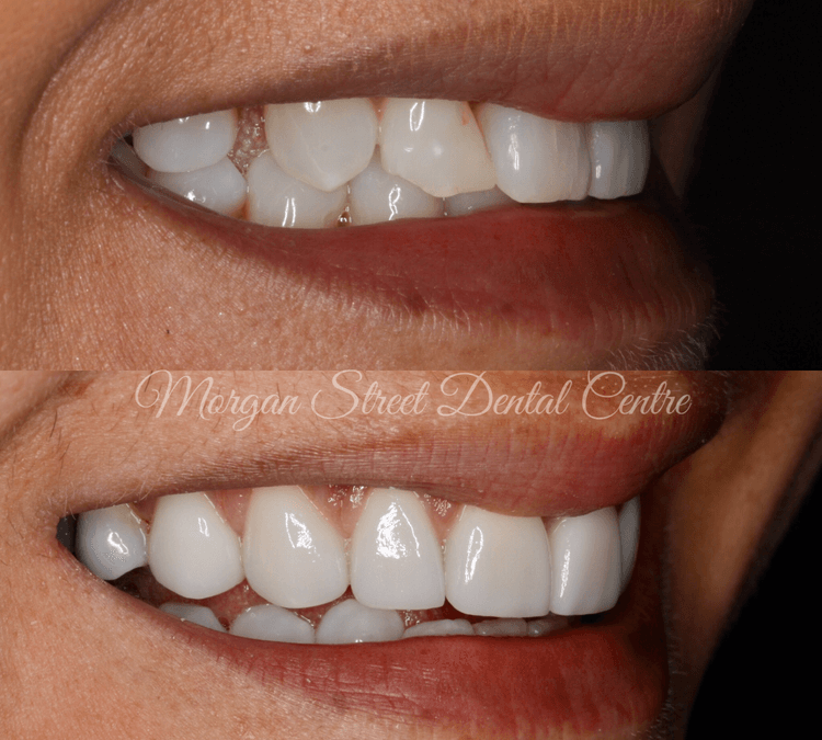 porcelain veneers