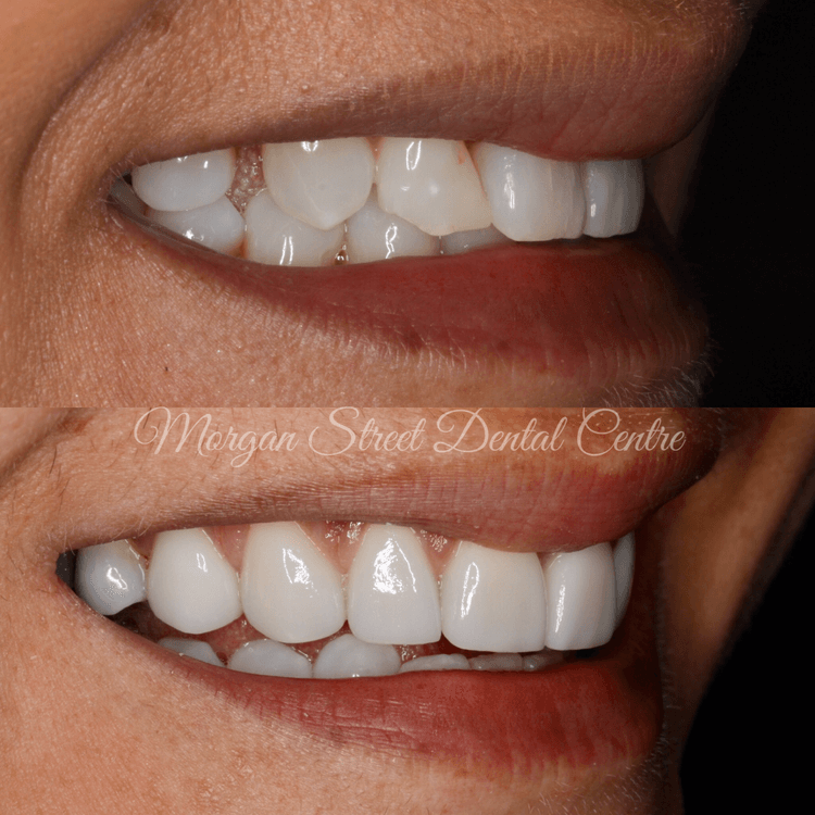 porcelain veneers