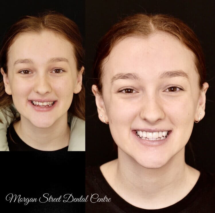 Morgan Street Dental Centre - Porcelain Veneers Before and After Image in Female Teen dentalwaggaporcelainveneers