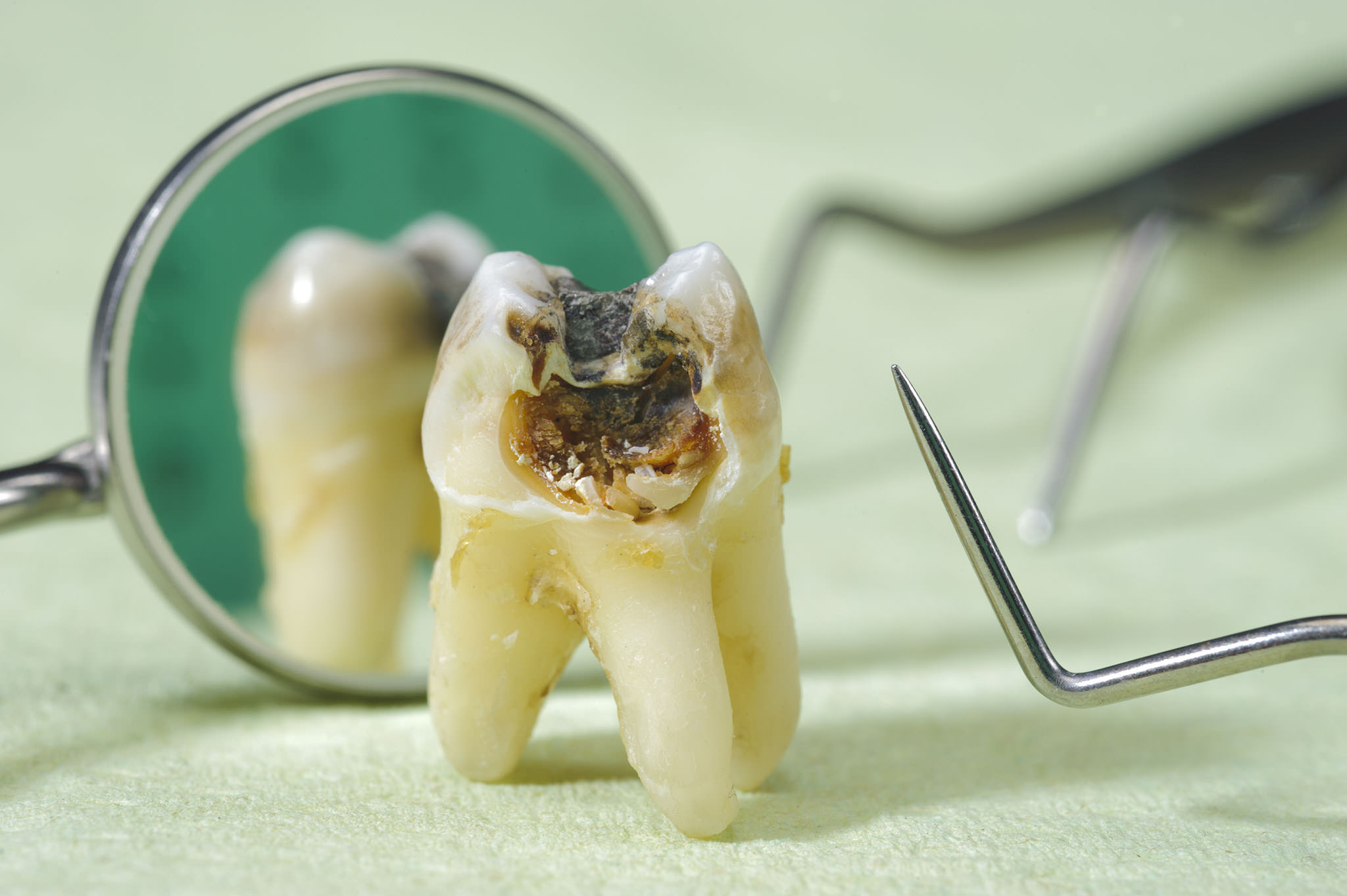 What do dental cavities look like and when to see a dentist?