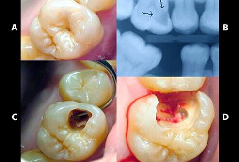 what do cavities look like before the treatment