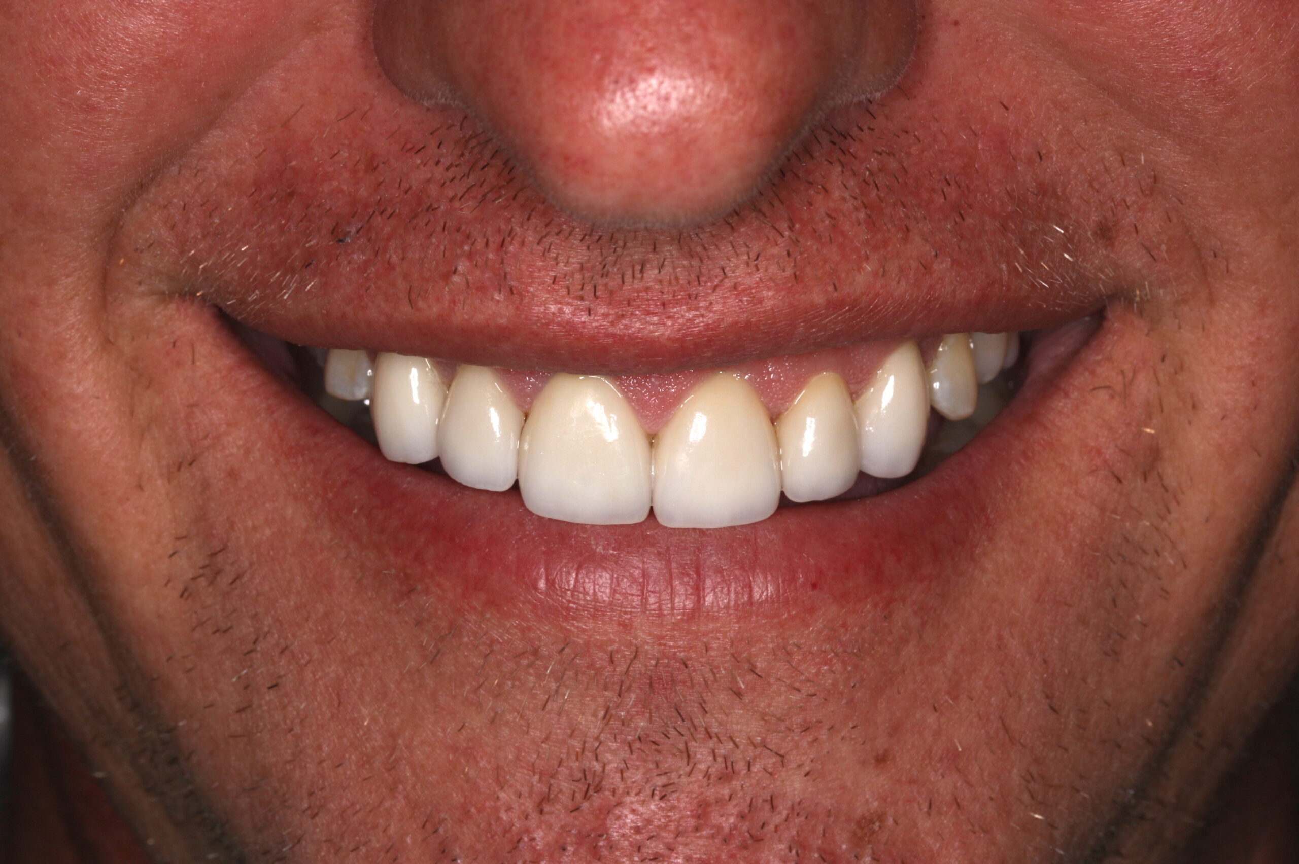 Morgan Street Dental Centre Smile Gallery - Before and After Images Smile Design Nathan Before Edited