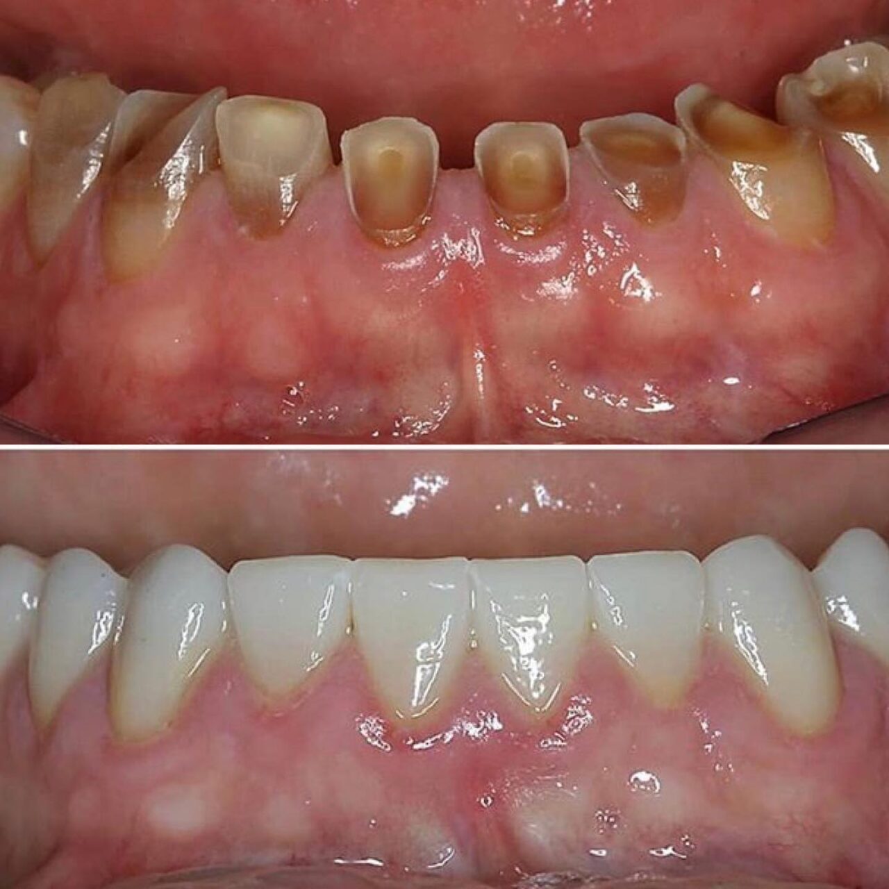 What Causes Tooth Wear?